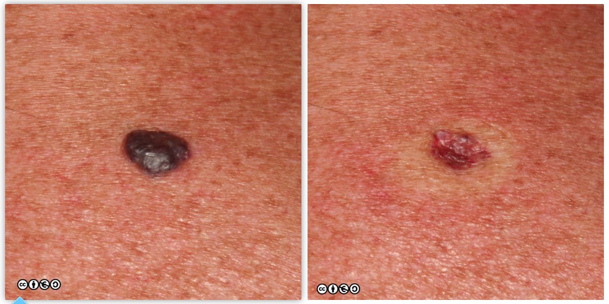 Skin Cancer (Melanoma): Overview, Risk Factors, Symptoms & Treatments
