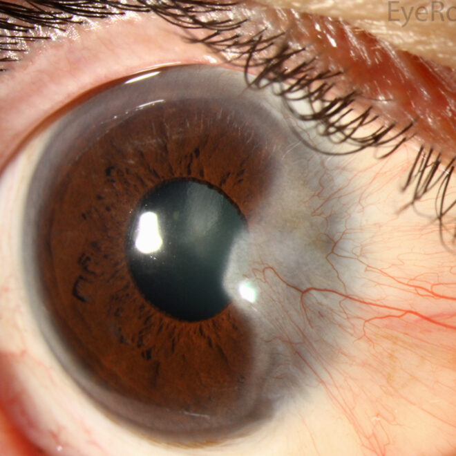 Pterygium: Causes, Symptoms, and Treatment Options