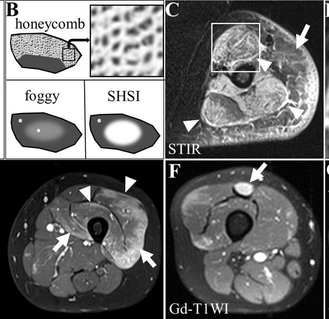 Inflammation of Muscles (Myositis): Causes, Symptoms, and Treatments