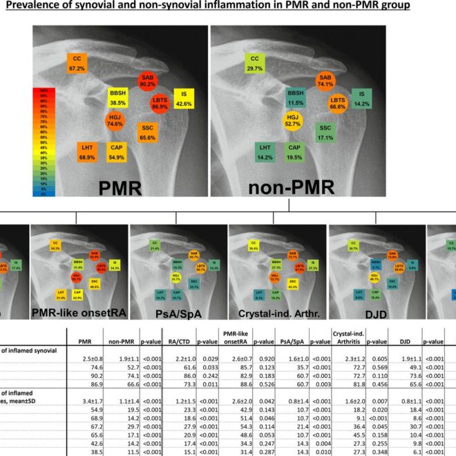 Polymyalgia Rheumatica: A Guide to Understanding the Condition (PMR)