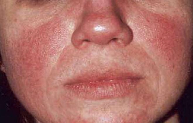 Rosacea: What It Is, Causes, Symptoms & Treatments