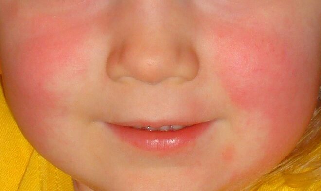 Scarlet Fever: Overview, Causes, Symptoms & Treatments