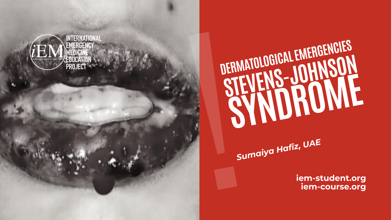 Stevens-Johnson Syndrome (SJS): Overview, Causes, Symptoms & Treatment