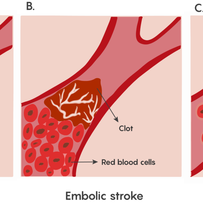 Stroke: What It Is, Types, Causes, Symptoms & Recovery
