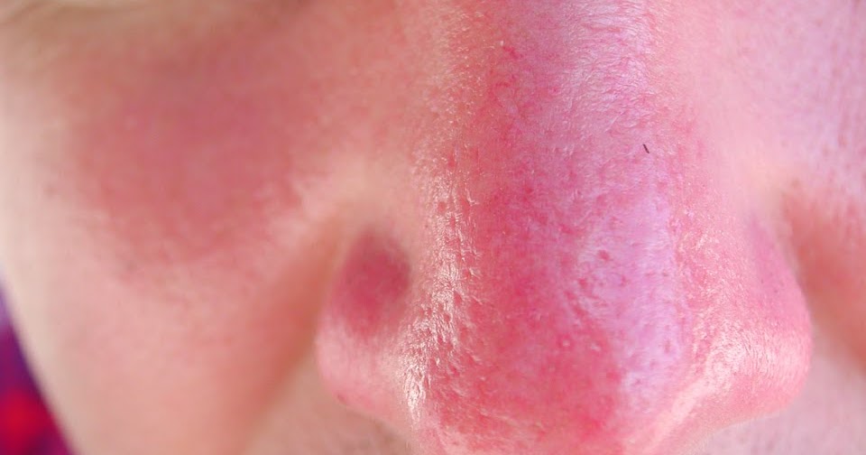 Sun Poisoning: Symptoms, Causes, Treatments, and Prevention
