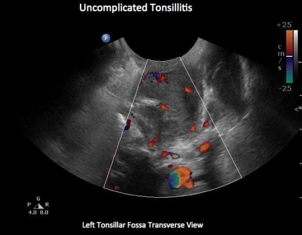 Tonsil Stones: Causes, Symptoms, and Removal Options