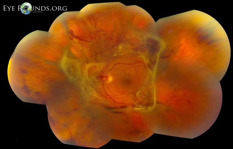 Retinal Detachment: Causes, Symptoms, Diagnosis, and Treatment
