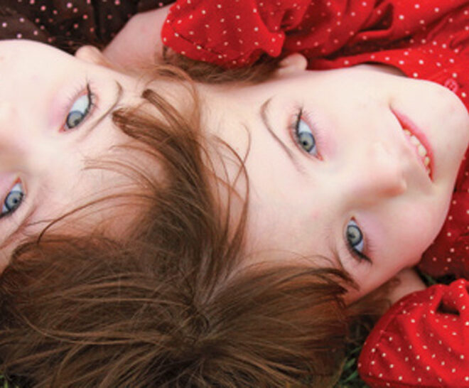 Conjoined Twins: Understanding the Condition, Causes, and Care Options
