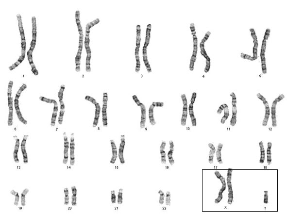 Klinefelter Syndrome (XXY Chromosome Disorder): Overview, Symptoms, Diagnosis & Care