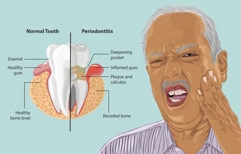 Gum Disease (Periodontal Disease): Overview, Causes, Symptoms & Care